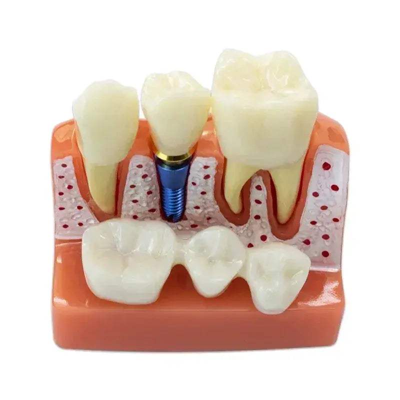 Dental Typodont Teaching Model With Removable Teeth - ToylandEU