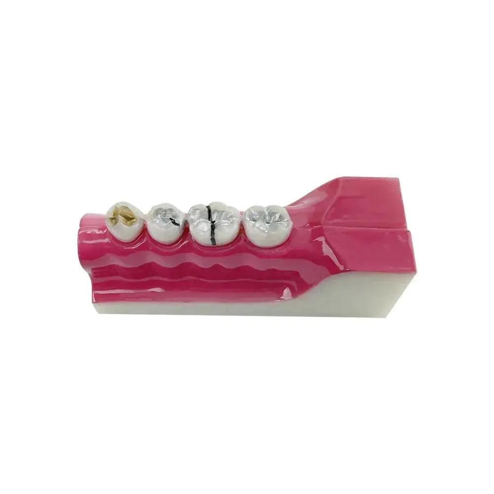 Dental Anatomy Model Molar Cross Section For Teaching - ToylandEU™