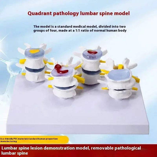 Lumbar Anatomy Model Disc Herniation Demonstration - ToylandEU™