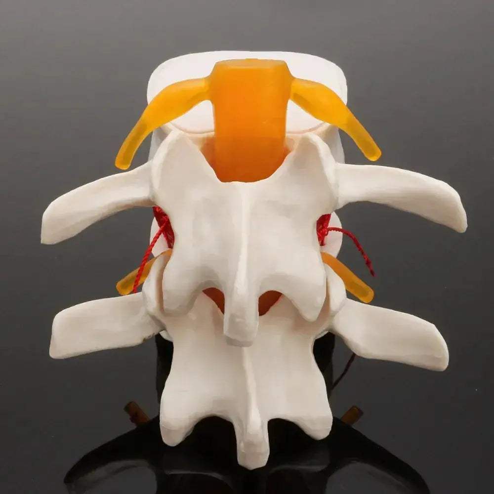 Lumbar Spine Disc Herniation Teaching Model for Medical Education - ToylandEU