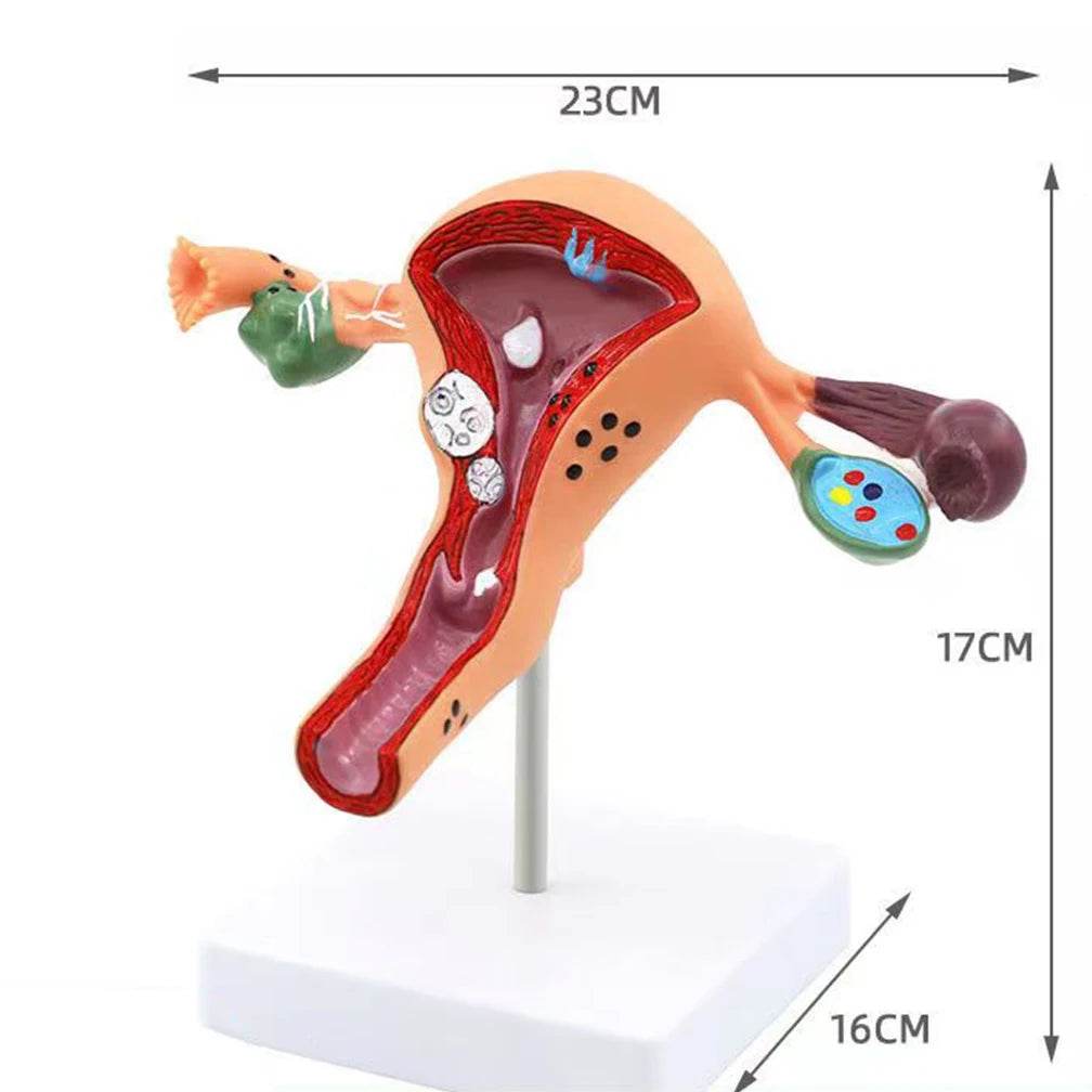 Cross Section Structure Model Human Pathological Uterus Ovary Model Uterus Anatomical Anatomy Female Organ Teaching Study Tool - ToylandEU