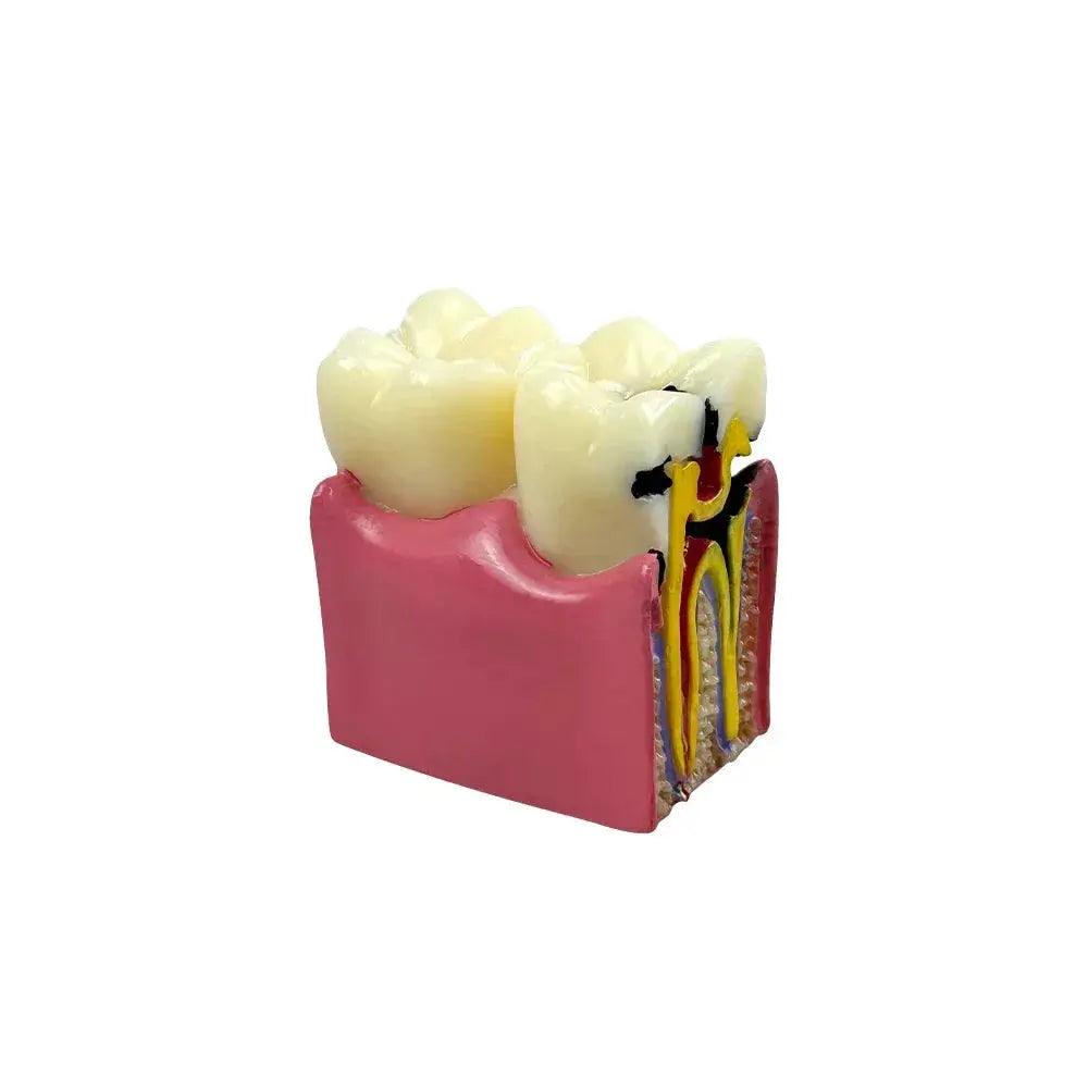  Dental Caries Comparison Models For Dentists Teaching -  ToylandEU™