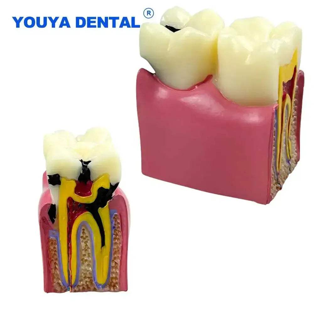 Dental Caries Comparison Models For Dentists Teaching Anatomy - ToylandEU
