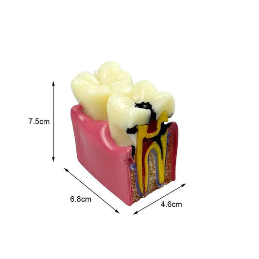  Dental Caries Comparison Models For Dentists Teaching -  ToylandEU™