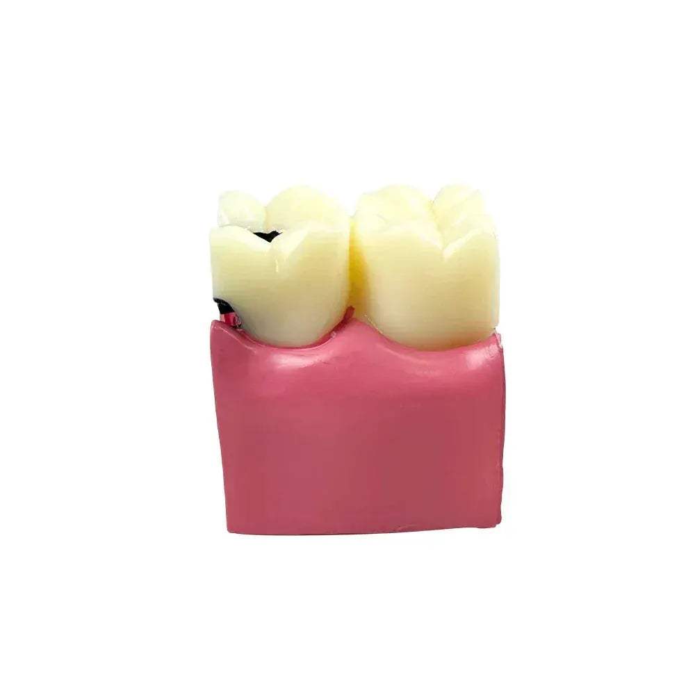 Dental Caries Comparison Models For Dentists Teaching Anatomy - ToylandEU