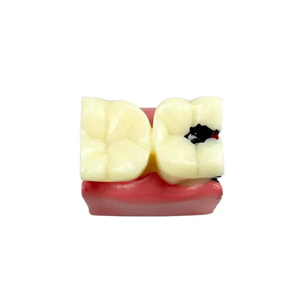 Dental Caries Comparison Models For Dentists Teaching Anatomy - ToylandEU