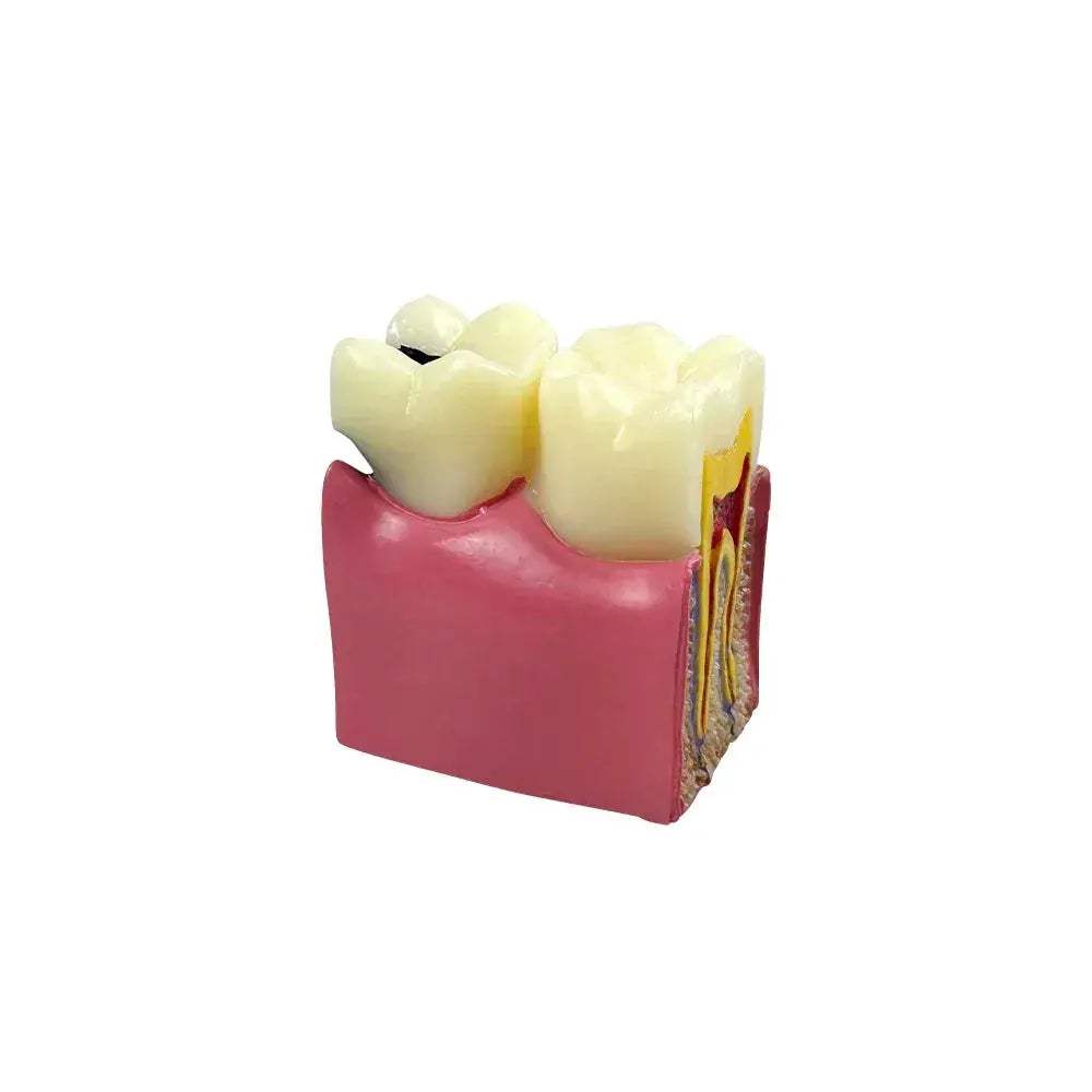 Dental Caries Comparison Models For Dentists Teaching Anatomy - ToylandEU