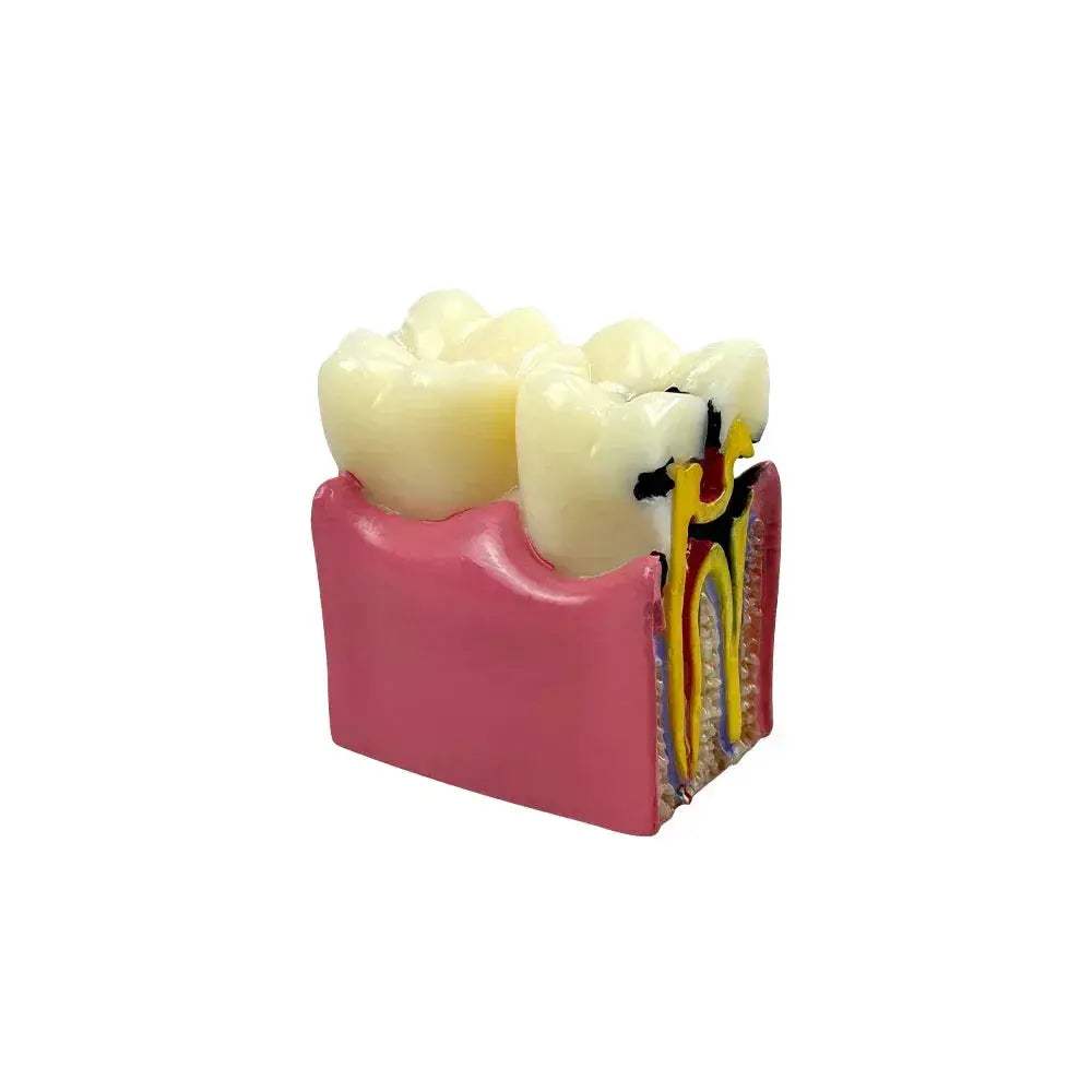 Dental Caries Comparison Models For Dentists Teaching Anatomy - ToylandEU