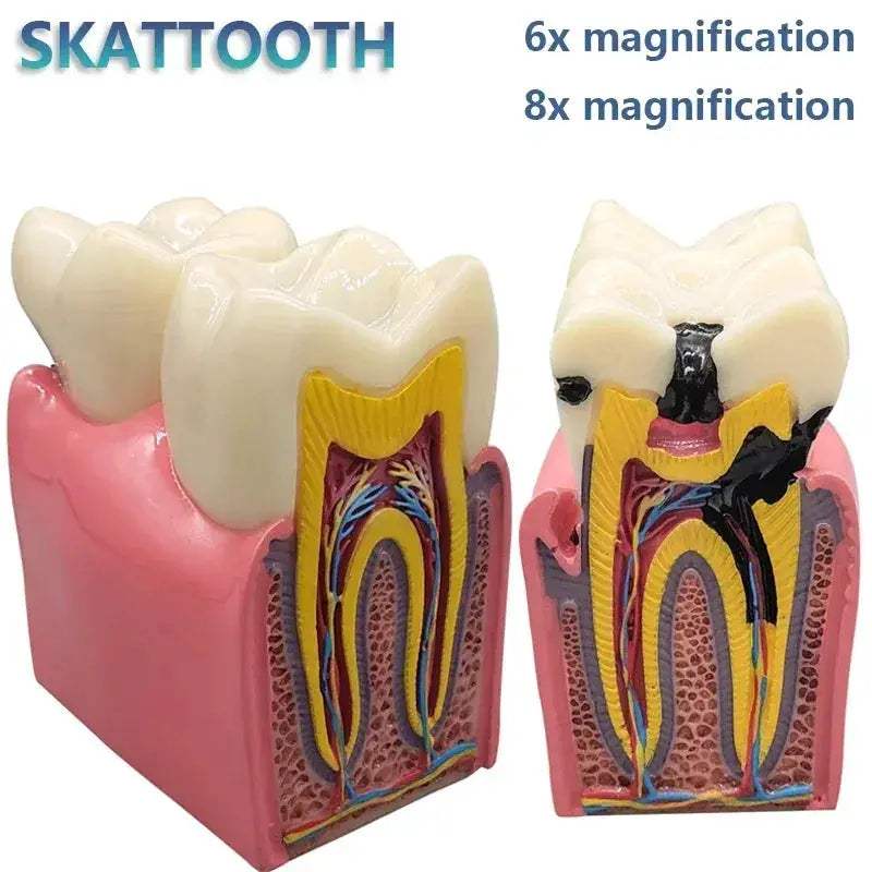 Dental Caries Demonstration Model For Teaching And Lab - ToylandEU