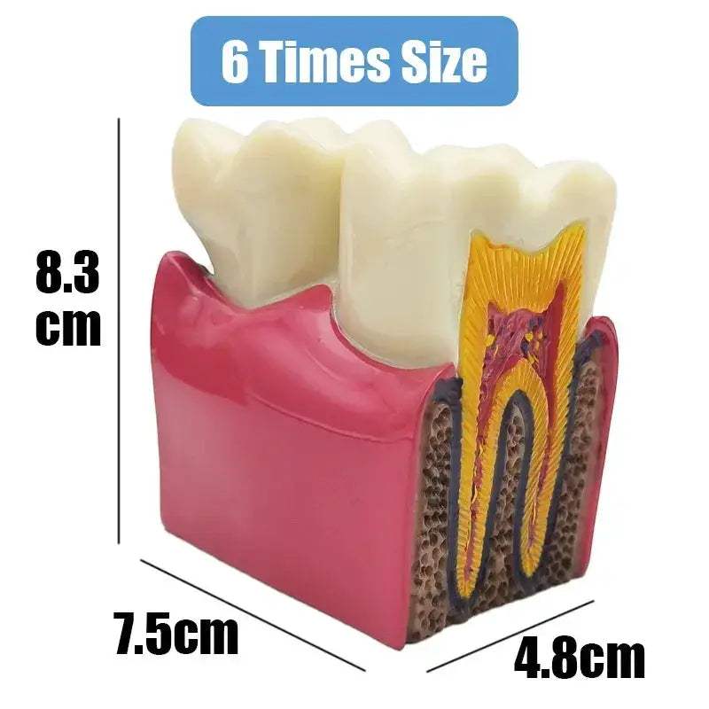 Dental Caries Demonstration Model For Teaching And Lab - ToylandEU