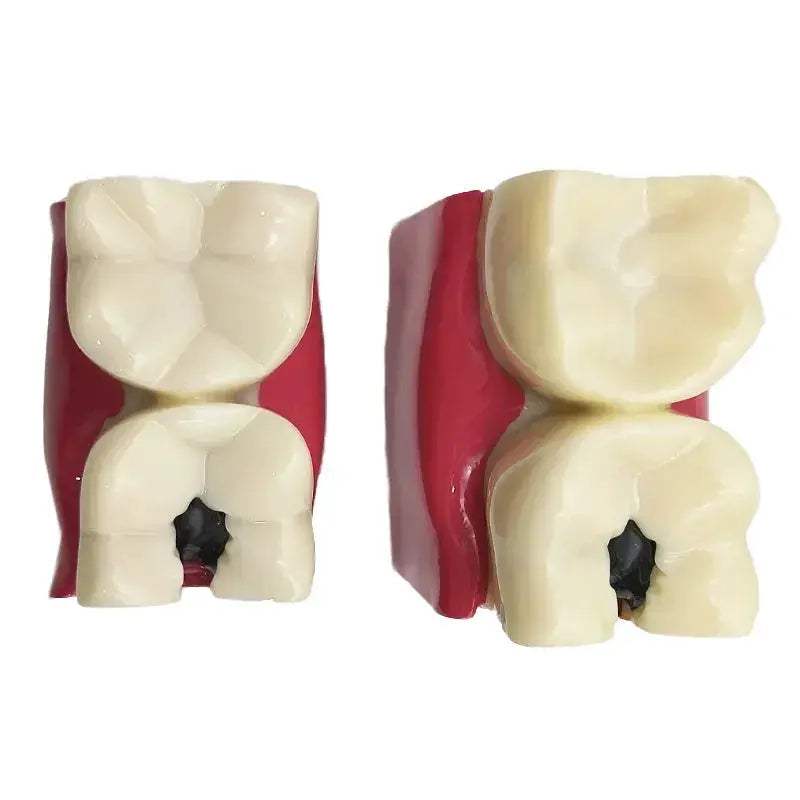 Dental Caries Demonstration Model For Teaching And Lab - ToylandEU