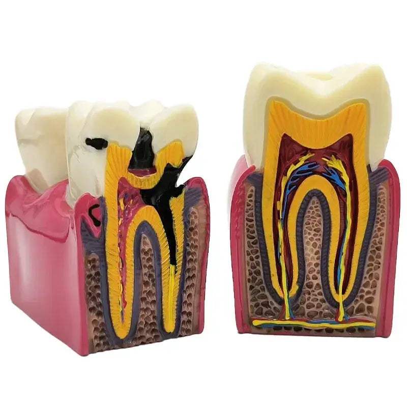 Dental Caries Demonstration Model For Teaching And Lab - ToylandEU