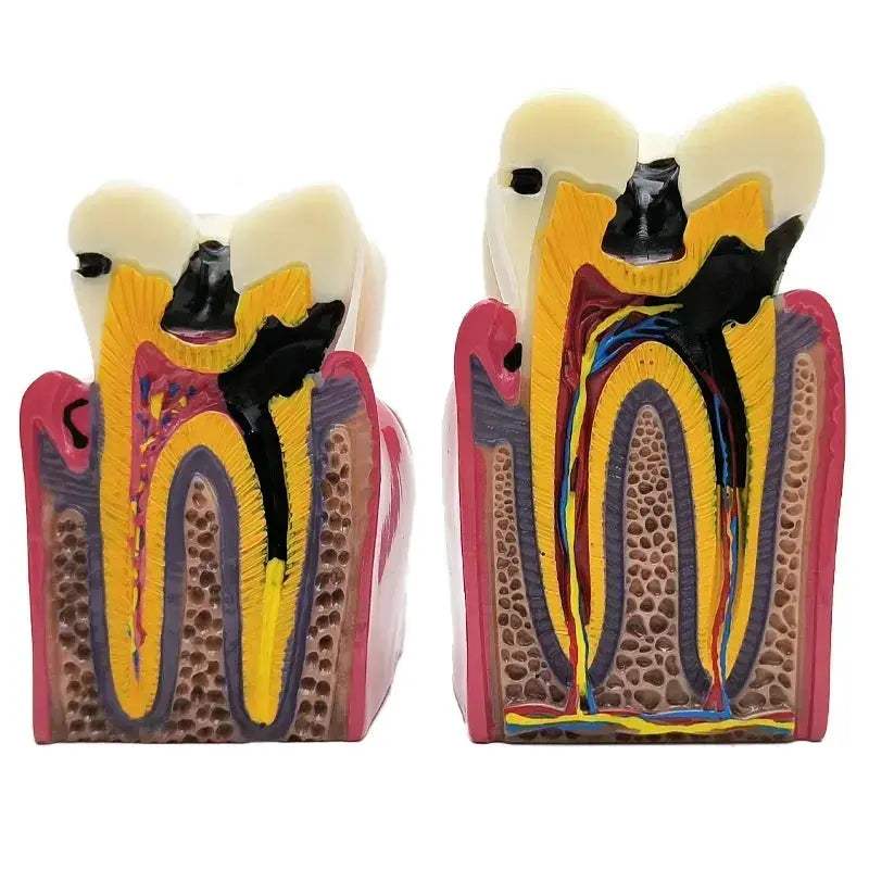 Dental Caries Demonstration Model For Teaching And Lab - ToylandEU