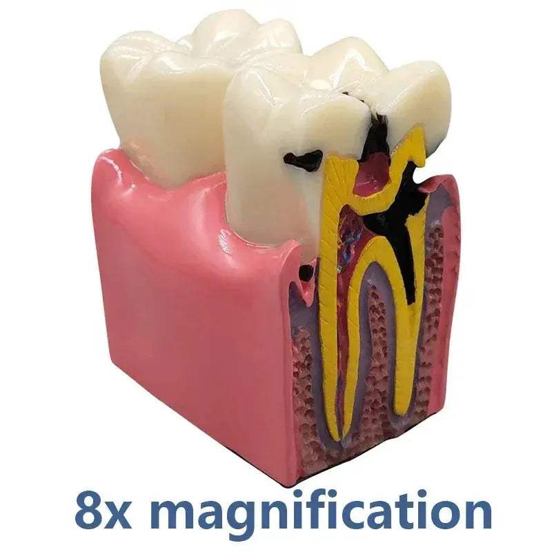 Dental Caries Demonstration Model For Teaching And Lab - ToylandEU