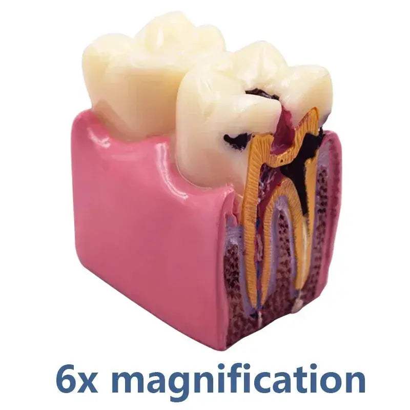 Dental Caries Demonstration Model For Teaching And Lab - ToylandEU