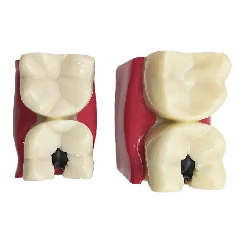  Dental Caries Demonstration Model for Teaching -  ToylandEU™