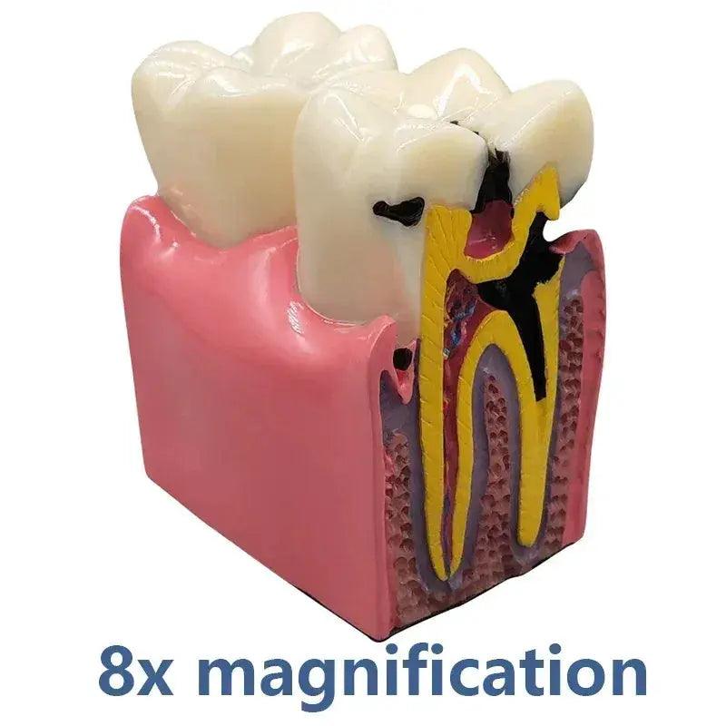  Dental Caries Demonstration Model for Teaching -  ToylandEU™