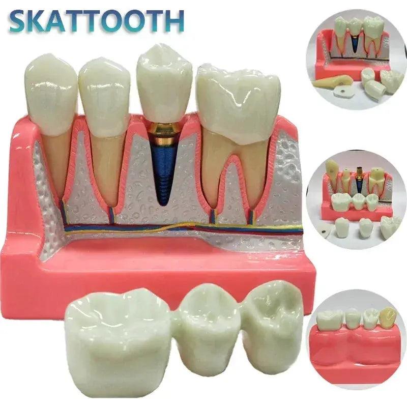  Dental Typodont Teaching Model With Removable Teeth -  ToylandEU™