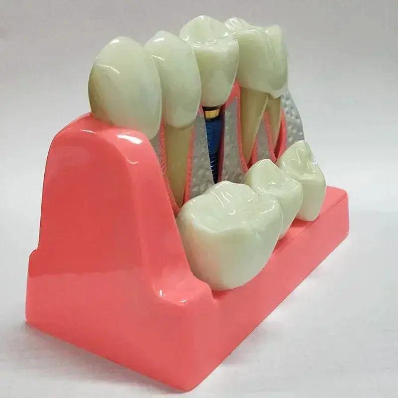  Dental Typodont Teaching Model With Removable Teeth -  ToylandEU™