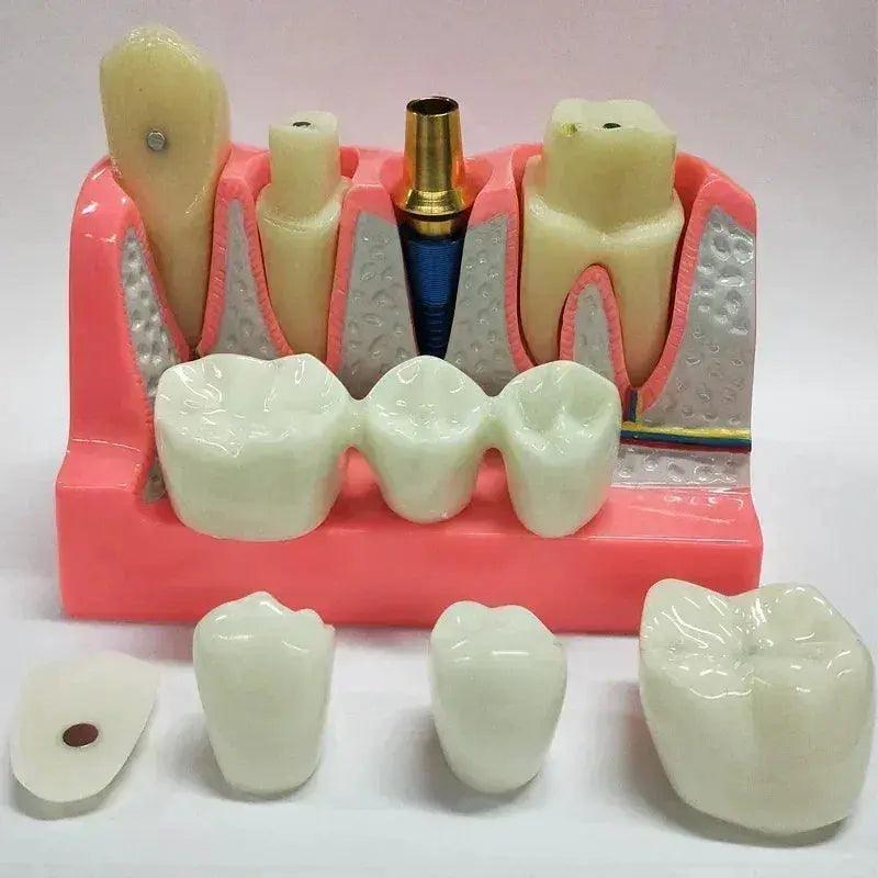 Dental Typodont Teaching Model With Removable Teeth -  ToylandEU™
