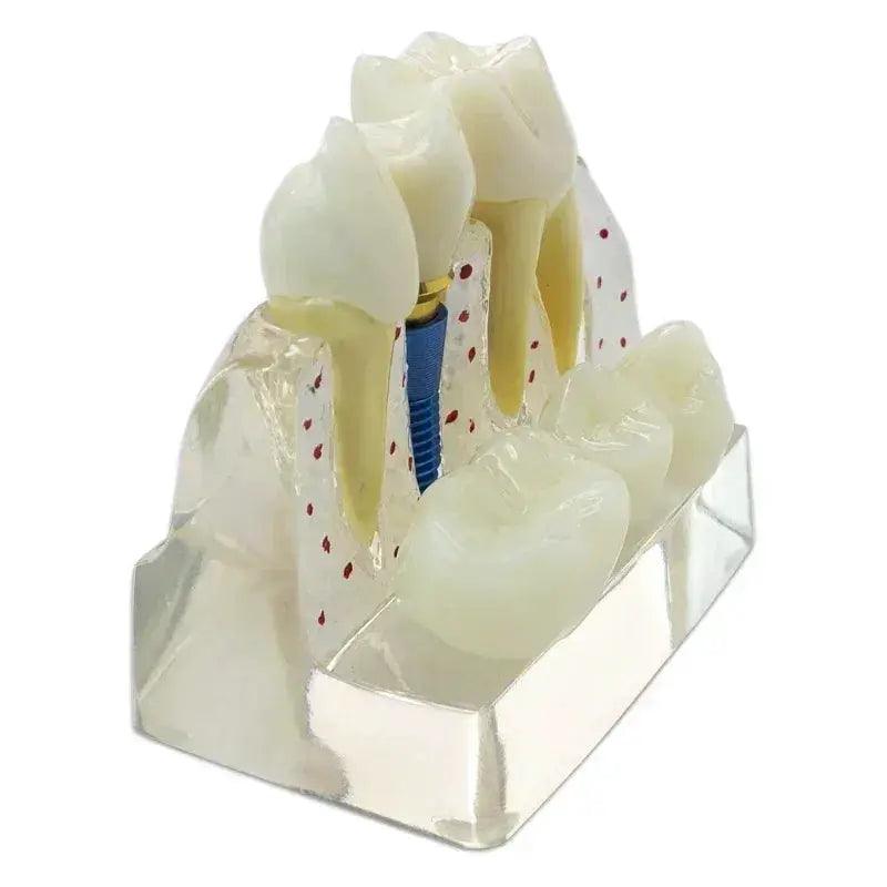  Dental Typodont Teaching Model With Removable Teeth -  ToylandEU™