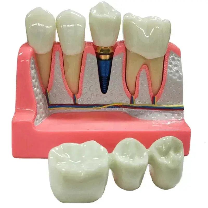  Dental Typodont Teaching Model With Removable Teeth -  ToylandEU™