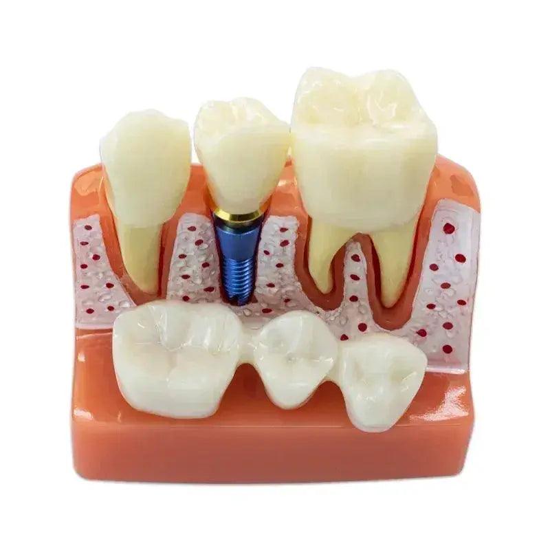  Dental Typodont Teaching Model With Removable Teeth -  ToylandEU™