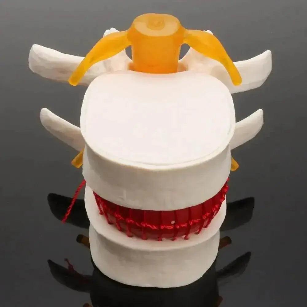  Human Anatomy Skeleton Spine Lumbar Disc Herniation Teaching Model Brain Skull Traumatic Pistol Medical School Supplies -  ToylandEU™