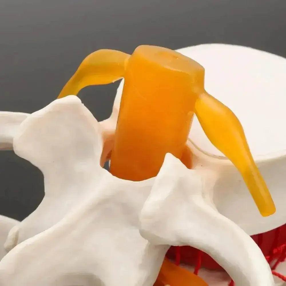  Human Anatomy Skeleton Spine Lumbar Disc Herniation Teaching Model Brain Skull Traumatic Pistol Medical School Supplies -  ToylandEU™
