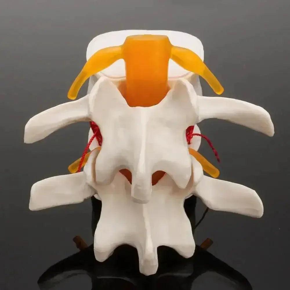  Human Anatomy Skeleton Spine Lumbar Disc Herniation Teaching Model Brain Skull Traumatic Pistol Medical School Supplies -  ToylandEU™