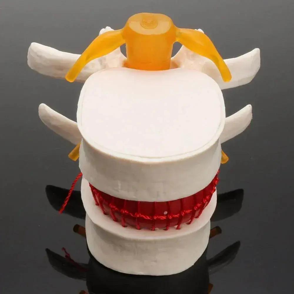  Human Anatomy Skeleton Spine Lumbar Disc Herniation Teaching Model Brain Skull Traumatic Pistol Medical School Supplies -  ToylandEU™
