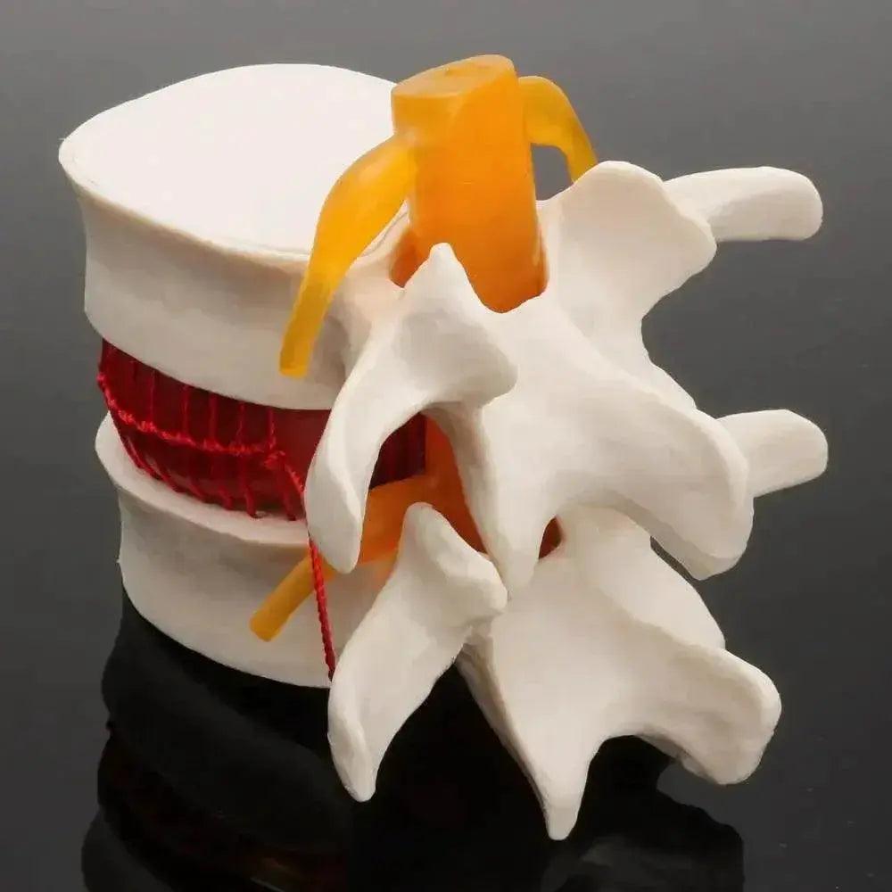  Human Anatomy Skeleton Spine Lumbar Disc Herniation Teaching Model Brain Skull Traumatic Pistol Medical School Supplies -  ToylandEU™