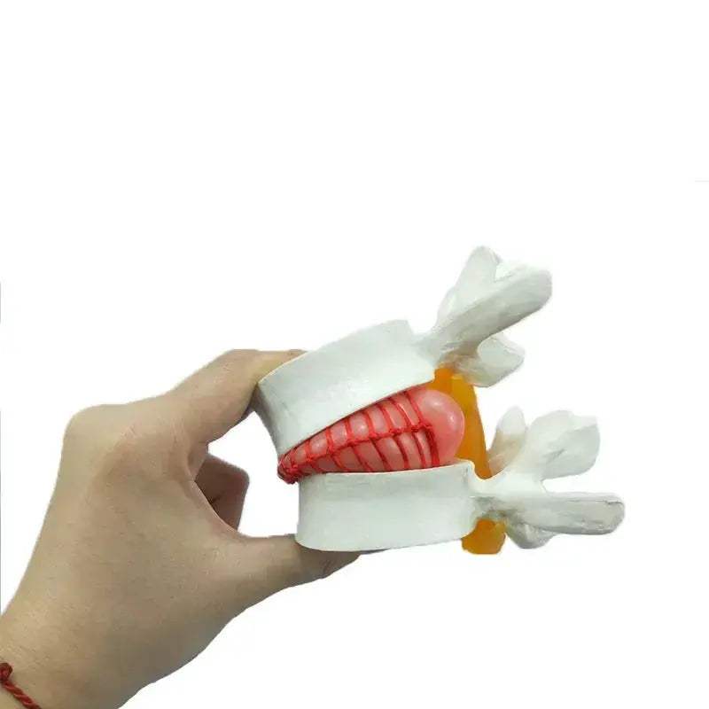 Enlarged Lumbar Spine Disc Herniation Demonstration Model for Medical Teaching - ToylandEU