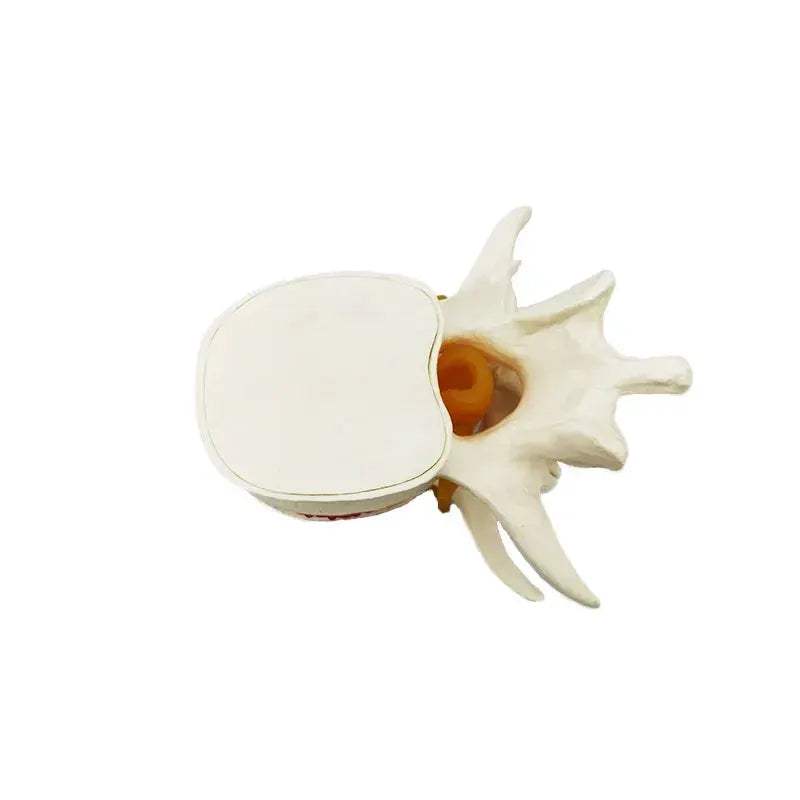 Enlarged Lumbar Spine Disc Herniation Demonstration Model for Medical Teaching - ToylandEU