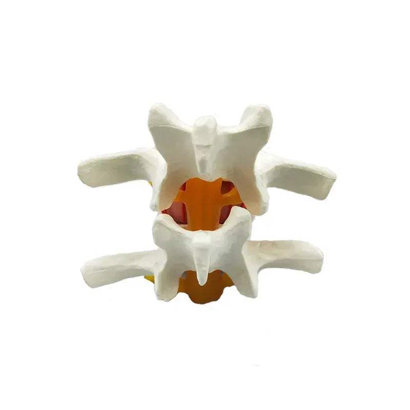 Enlarged Lumbar Spine Disc Herniation Demonstration Model for Medical Teaching - ToylandEU