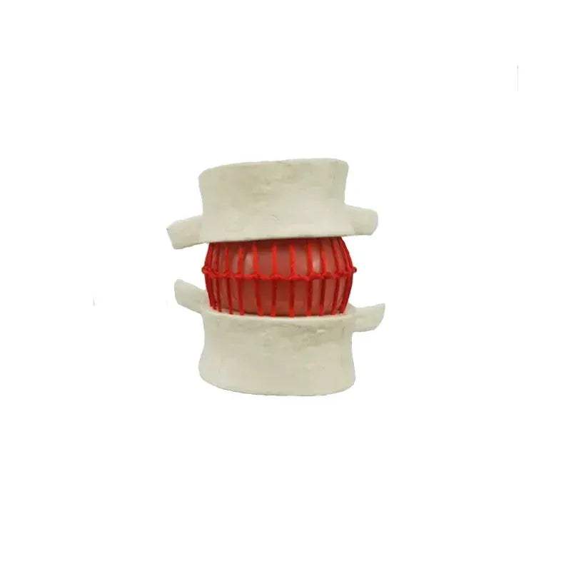 Enlarged Lumbar Spine Disc Herniation Demonstration Model for Medical Teaching - ToylandEU