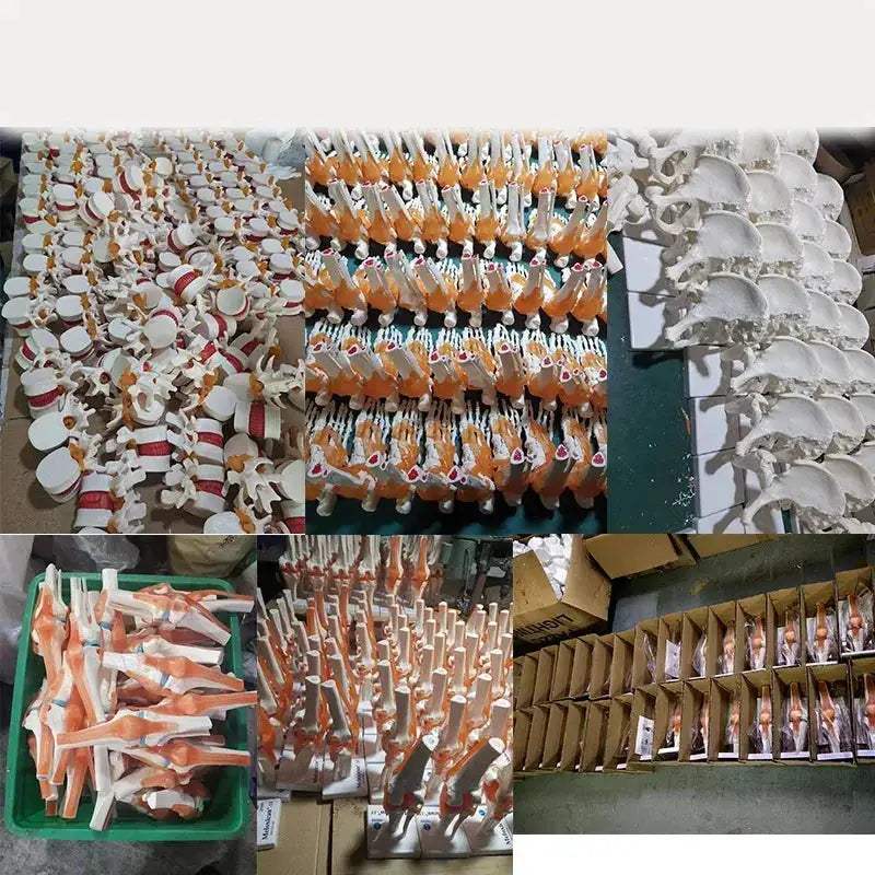 Enlarged Lumbar Spine Disc Herniation Demonstration Model for Medical Teaching - ToylandEU