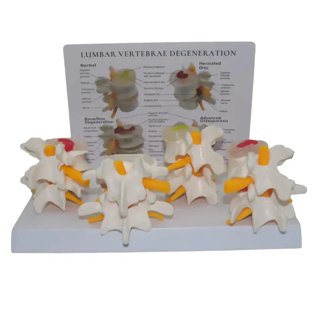 Four Stage Pathological Lumbar Bone Model For Medical Teaching - ToylandEU