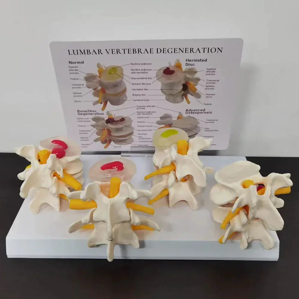 Four Stage Pathological Lumbar Bone Model For Medical Teaching - ToylandEU