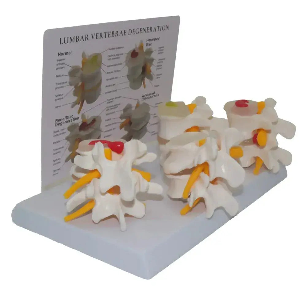 Four Stage Pathological Lumbar Bone Model For Medical Teaching - ToylandEU