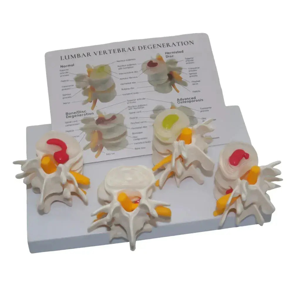 Four Stage Pathological Lumbar Bone Model For Medical Teaching - ToylandEU