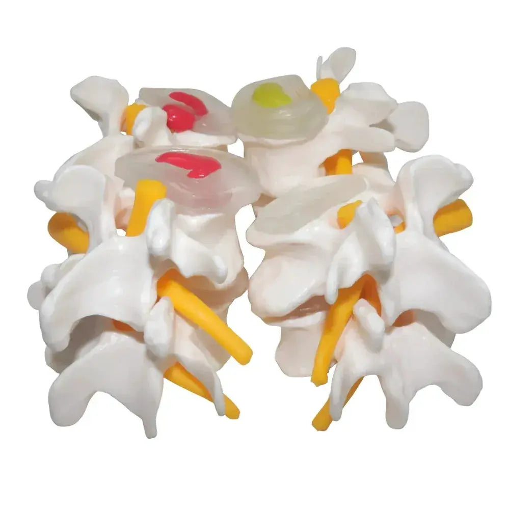 Four Stage Pathological Lumbar Bone Model For Medical Teaching - ToylandEU