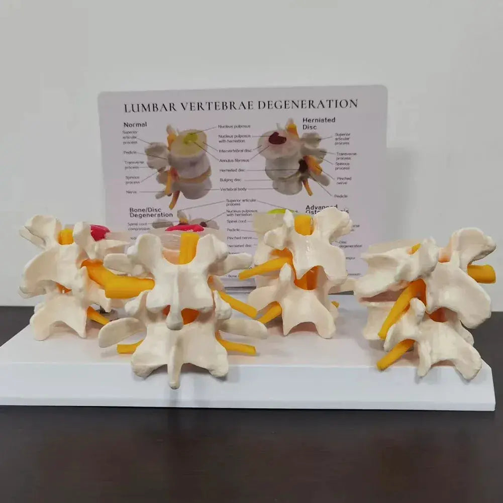 Four Stage Pathological Lumbar Bone Model For Medical Teaching - ToylandEU