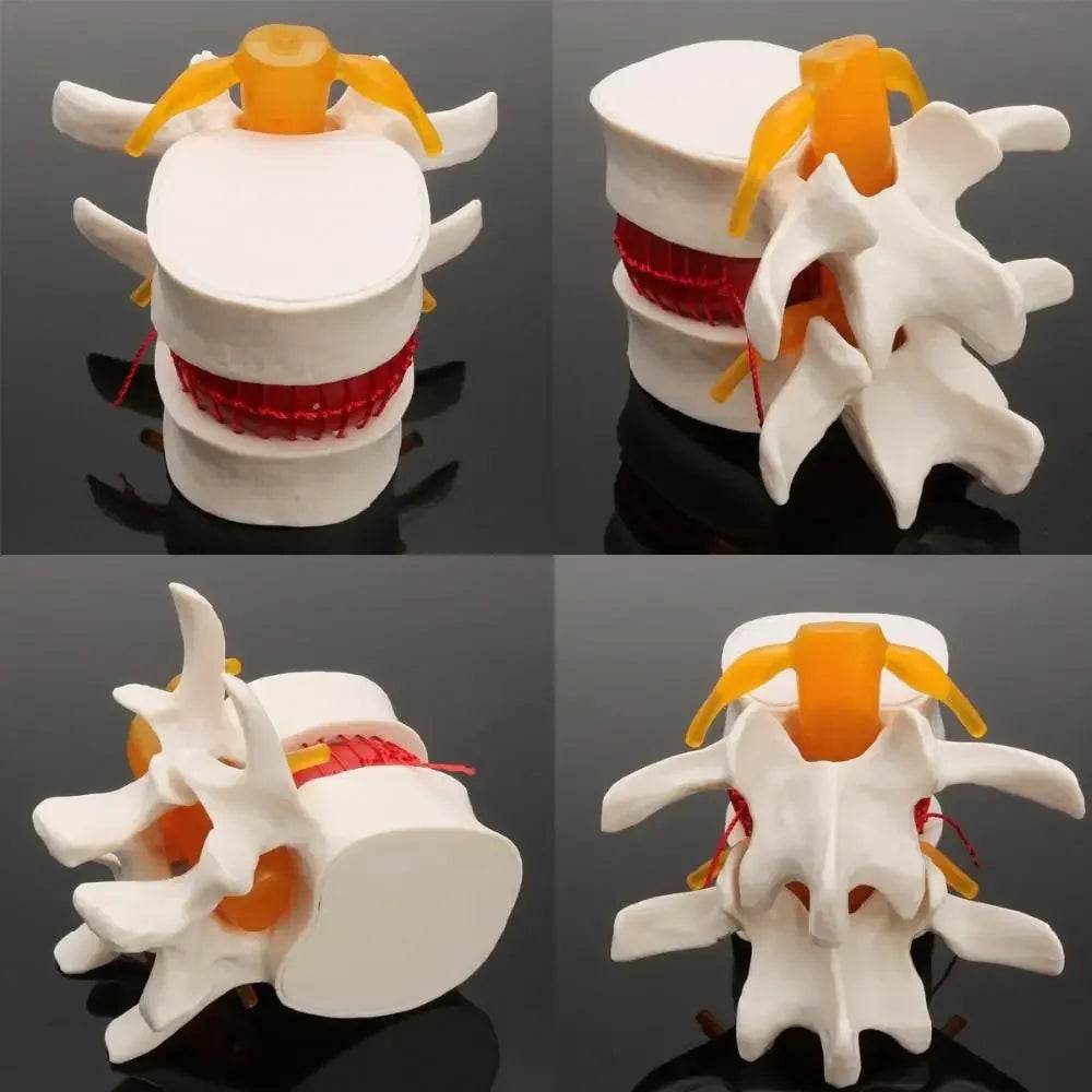Human Anatomy Skeleton Spine Lumbar Disc Herniation Teaching Model Brain Skull Traumatic Pistol Medical School Supplies - ToylandEU