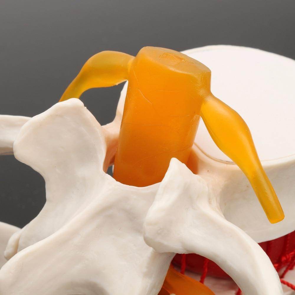 Human Anatomy Skeleton Spine Lumbar Disc Herniation Teaching Model Brain Skull Traumatic Pistol Medical School Supplies - ToylandEU