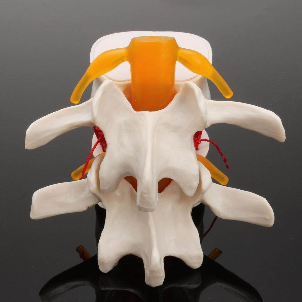 Human Anatomy Skeleton Spine Lumbar Disc Herniation Teaching Model Brain Skull Traumatic Pistol Medical School Supplies - ToylandEU