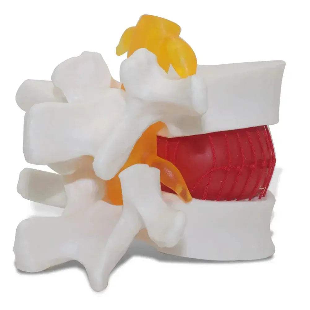 Intervertebral Disc Herniation Demonstration Model for Medical Teaching - ToylandEU