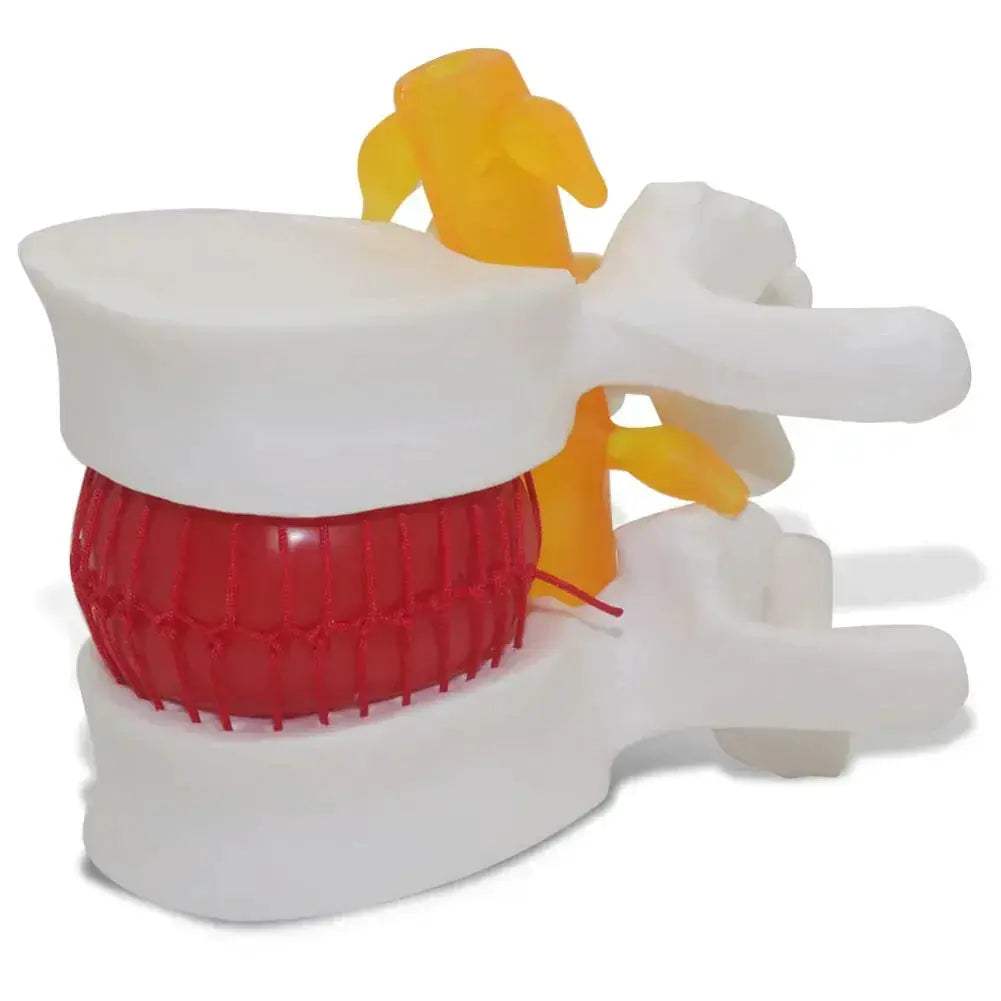 Intervertebral Disc Herniation Demonstration Model for Medical Teaching - ToylandEU