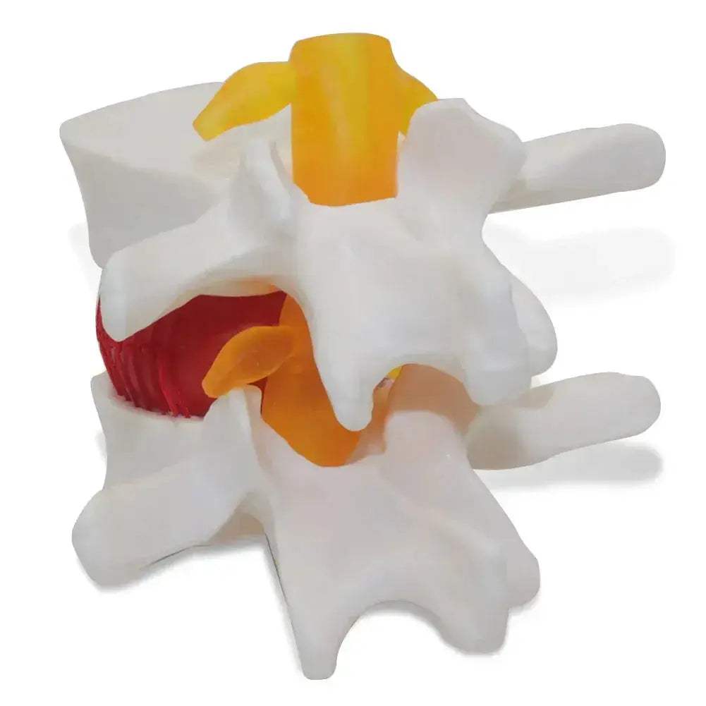 Intervertebral Disc Herniation Demonstration Model for Medical Teaching - ToylandEU