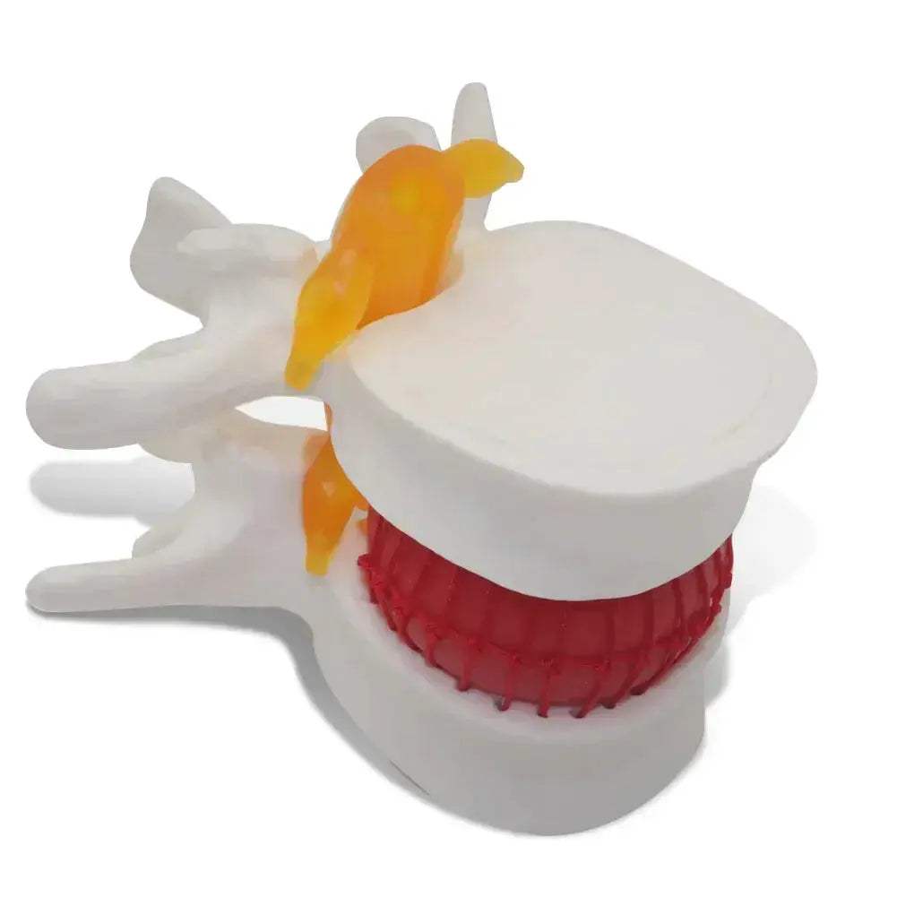 Intervertebral Disc Herniation Demonstration Model for Medical Teaching - ToylandEU